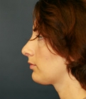 Feel Beautiful - Chin implant San Diego case 6 - After Photo